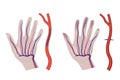 vibration syndrome. Hand with a diagram of constricted blood vessels.